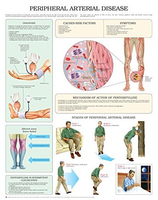 Read Peripheral arterial Disease e chart: Full illustrated - HC-HealthComm | PDF